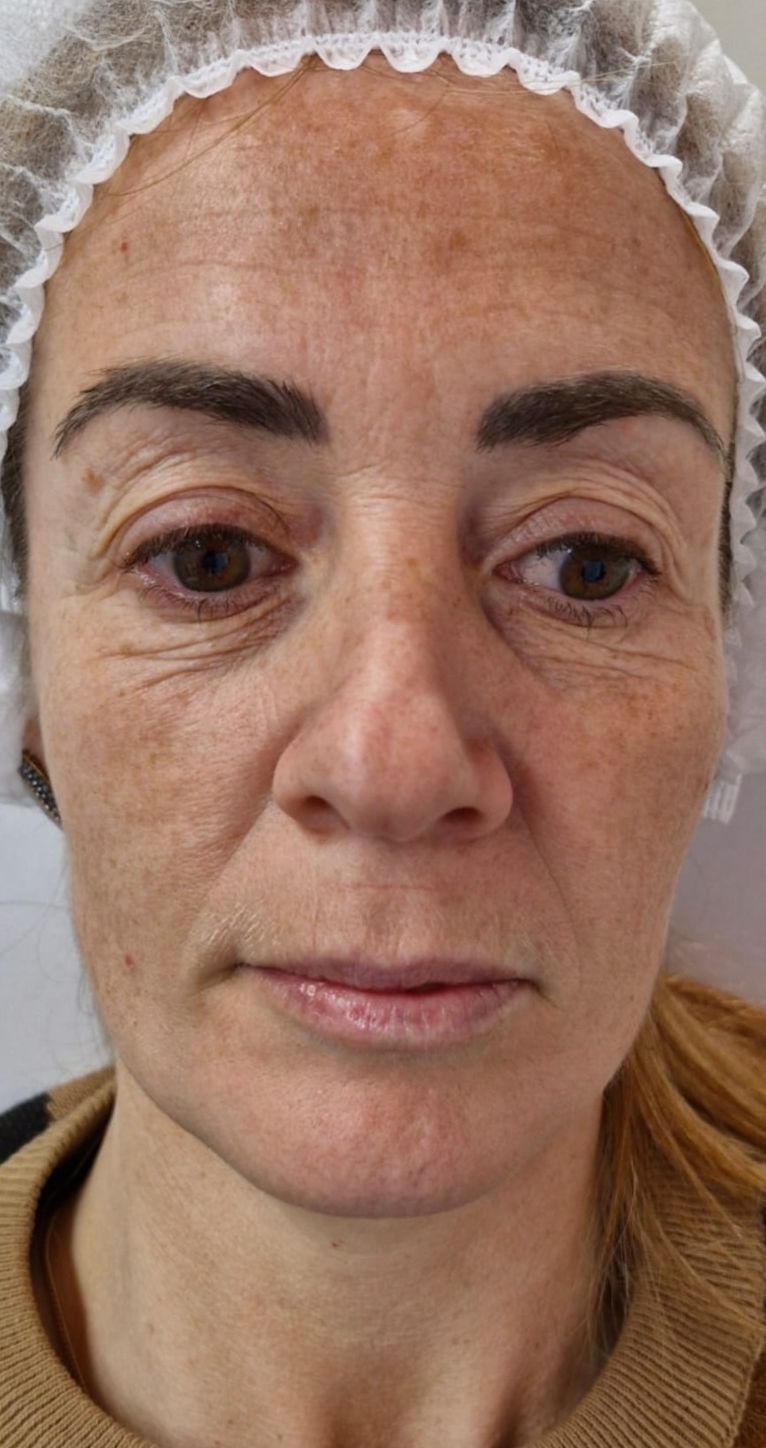 Before treatment